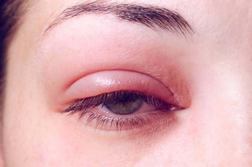chalazion eye